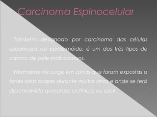Carcinoma Espinocelular
Também designado por carcinoma das células
escamosas ou epidermóide, é um dos três tipos de
cancro de pele mais comuns.
Normalmente surge em zonas que foram expostas a
fortes raios solares durante muitos anos e onde se terá
desenvolvido queratose actínica, ou solar.
 