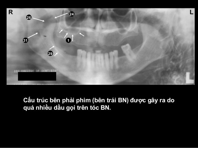 GP Oral Tren 250 mcg needs
