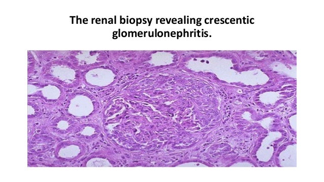 goodpasture syndrome 14 638