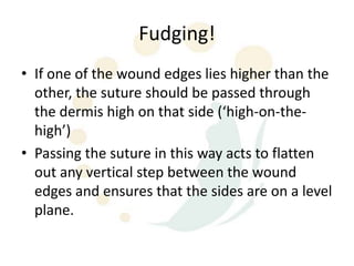 Fudging!
• If one of the wound edges lies higher than the
  other, the suture should be passed through
  the dermis high on that side (‘high-on-the-
  high’)
• Passing the suture in this way acts to flatten
  out any vertical step between the wound
  edges and ensures that the sides are on a level
  plane.
 
