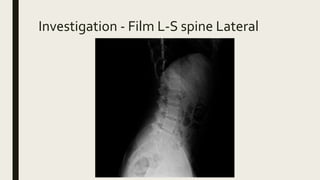 Investigation - Film L-S spine Lateral
 