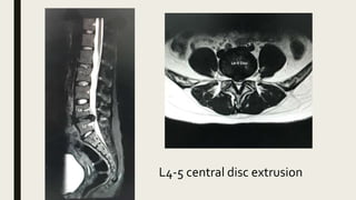 L4-5 central disc extrusion
 