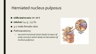 Herniated nucleus pulposus
■ พบได้ในกลุ่มผู้ป่วยอายุน้อย 25-40 ปี
■ มักเป็นที่ระดับ L4-5 , L5-S1
■ 3:1 male:female ratio
■ Pathoanatomy
– recurrent torsional strain leads to tears of
outer annulus which leads to herniation of
nucleus pulposus
 