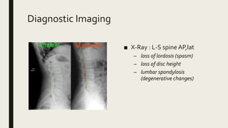 Diagnostic Imaging
■ X-Ray : L-S spine AP,lat
– loss of lordosis (spasm)
– loss of disc height
– lumbar spondylosis
(degenerative changes)
 