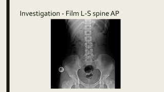 Investigation - Film L-S spine AP
 