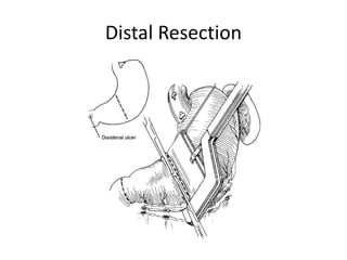 Bar Resection gastric resection, reconstruction and post gastrectomy syndromes | PPTX