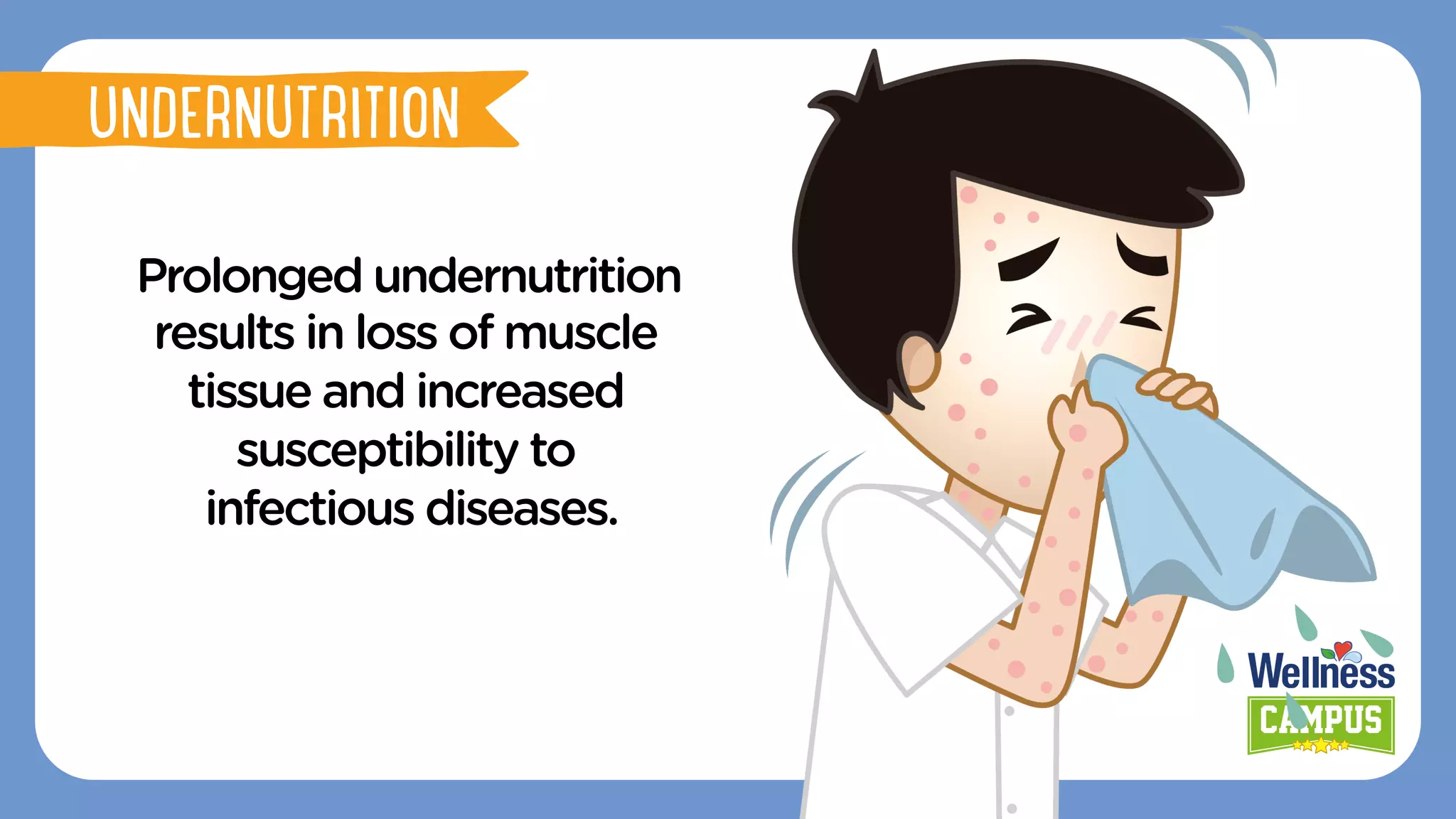 Prolonged undernutrition
results in loss of muscle
tissue and increased
susceptibility to
infectious diseases.
UNDERNUTRITION
 