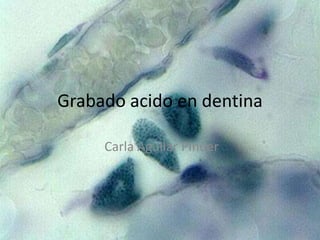 Grabado acido en dentina

     Carla Aguilar Pinuer
 