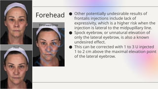Frontalis Injection Depth Rates Grabb Botulinum Toxin the mechanism of action.pptx