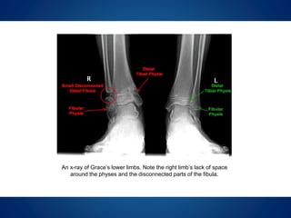 I was concerned that this small amount of
bone would be insufficient to buttress and
protect her ankle. In addition, the ankle was
bowing (varus) and surgery would become a
necessity if it continued to drift into a more
varus position.
 