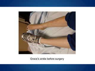 Grace’s ankle before surgery
 