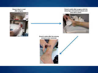 Grace’s ankle after the sutures
and pins were removed.
Grace’s leg in a cast
after surgery.
Grace’s ankle after surgery with the
dressings removed but sutures and
pins still in place.
 