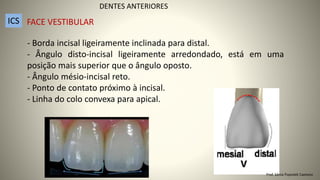 - Borda incisal ligeiramente inclinada para distal.
- Ângulo disto-incisal ligeiramente arredondado, está em uma
posição mais superior que o ângulo oposto.
- Ângulo mésio-incisal reto.
- Ponto de contato próximo à incisal.
- Linha do colo convexa para apical.
DENTES ANTERIORES
ICS FACE VESTIBULAR
Prof. Sônia Popiolek Caetano
 