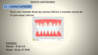 CS - CANINO SUPERIOR
DENTES ANTERIORES
Oclui com metade distal do canino inferior e metade mesial do
1º pré-molar inferior.
Contatos:
Mesial - D do ILS
Distal - M do 1º PMS
 
