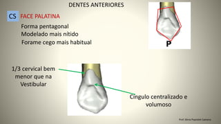 Forma pentagonal
Modelado mais nítido
Cíngulo centralizado e
volumoso
DENTES ANTERIORES
CS FACE PALATINA
1/3 cervical bem
menor que na
Vestibular
Forame cego mais habitual
Prof. Sônia Popiolek Caetano
 