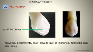 Frequente, proeminente, mais elevada que as marginais, formando duas
fossas rasas.
DENTES ANTERIORES
CS FACE PALATINA
CRISTA MEDIANA
Prof. Sônia Popiolek Caetano
 