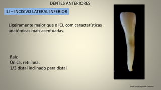 Prof. Sônia Popiolek Caetano
DENTES ANTERIORES
ILI – INCISIVO LATERAL INFERIOR
Raiz
Única, retilínea.
1/3 distal inclinado para distal
Ligeiramente maior que o ICI, com características
anatômicas mais acentuadas.
 
