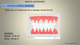 Prof. Sônia Popiolek Caetano
DENTES ANTERIORES
ILI – INCISIVO LATERAL INFERIOR
Contatos:
Mesial - D do ICI
Distal - M do CI
Oclui com 1/3 distal do ICS e metade mesial do ILS.
 