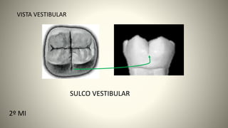 29
VISTA VESTIBULAR
SULCO VESTIBULAR
2º MI
 