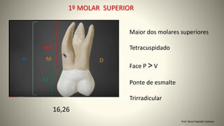 1º MOLAR SUPERIOR
Prof. Sônia Popiolek Caetano
16,26
Maior dos molares superiores
Tetracuspidado
Face P > V
Ponte de esmalte
Trirradicular
 