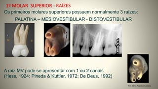 1º MOLAR SUPERIOR - RAÍZES
Prof. Sônia Popiolek Caetano
Os primeiros molares superiores possuem normalmente 3 raízes:
A raiz MV pode se apresentar com 1 ou 2 canais
(Hess, 1924; Pineda & Kuttler, 1972; De Deus, 1992)
PALATINA – MESIOVESTIBULAR - DISTOVESTIBULAR
 