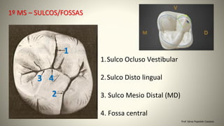 Prof. Sônia Popiolek Caetano
1º MS – SULCOS/FOSSAS
1.Sulco Ocluso Vestibular
2.Sulco Disto lingual
3. Sulco Mesio Distal (MD)
4. Fossa central
4
3
2
1
 