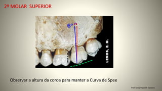 Prof. Sônia Popiolek Caetano
2º MOLAR SUPERIOR
Observar a altura da coroa para manter a Curva de Spee
 