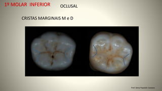 OCLUSAL
CRISTAS MARGINAIS M e D
Prof. Sônia Popiolek Caetano
1º MOLAR INFERIOR
 