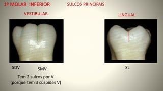 1º MOLAR INFERIOR SULCOS PRINCIPAIS
VESTIBULAR LINGUAL
SMV SL
SDV
Tem 2 sulcos por V
(porque tem 3 cúspides V)
 