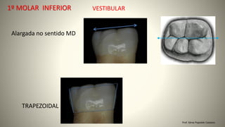 VESTIBULAR
TRAPEZOIDAL
Alargada no sentido MD
Prof. Sônia Popiolek Caetano
1º MOLAR INFERIOR
 