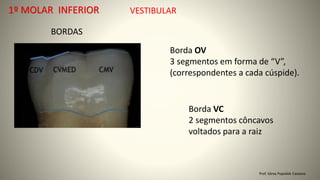VESTIBULAR
BORDAS
Borda OV
3 segmentos em forma de “V”,
(correspondentes a cada cúspide).
Borda VC
2 segmentos côncavos
voltados para a raiz
Prof. Sônia Popiolek Caetano
1º MOLAR INFERIOR
 