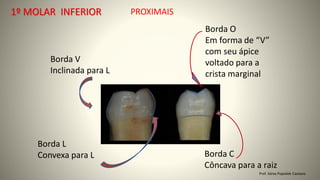 PROXIMAIS
Borda V
Inclinada para L
Borda L
Convexa para L Borda C
Côncava para a raiz
Borda O
Em forma de “V”
com seu ápice
voltado para a
crista marginal
Prof. Sônia Popiolek Caetano
1º MOLAR INFERIOR
 