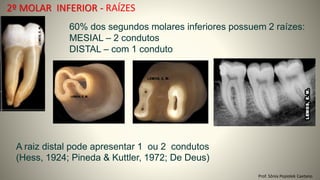 2º MOLAR INFERIOR - RAÍZES
Prof. Sônia Popiolek Caetano
60% dos segundos molares inferiores possuem 2 raízes:
MESIAL – 2 condutos
DISTAL – com 1 conduto
A raiz distal pode apresentar 1 ou 2 condutos
(Hess, 1924; Pineda & Kuttler, 1972; De Deus)
 