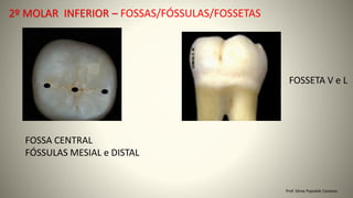 FOSSA CENTRAL
FÓSSULAS MESIAL e DISTAL
Prof. Sônia Popiolek Caetano
2º MOLAR INFERIOR – FOSSAS/FÓSSULAS/FOSSETAS
FOSSETA V e L
 