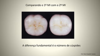 Comparando o 1º MI com o 2º MI
A diferença fundamental é o número de cúspides
Prof. Sônia Popiolek Caetano
 