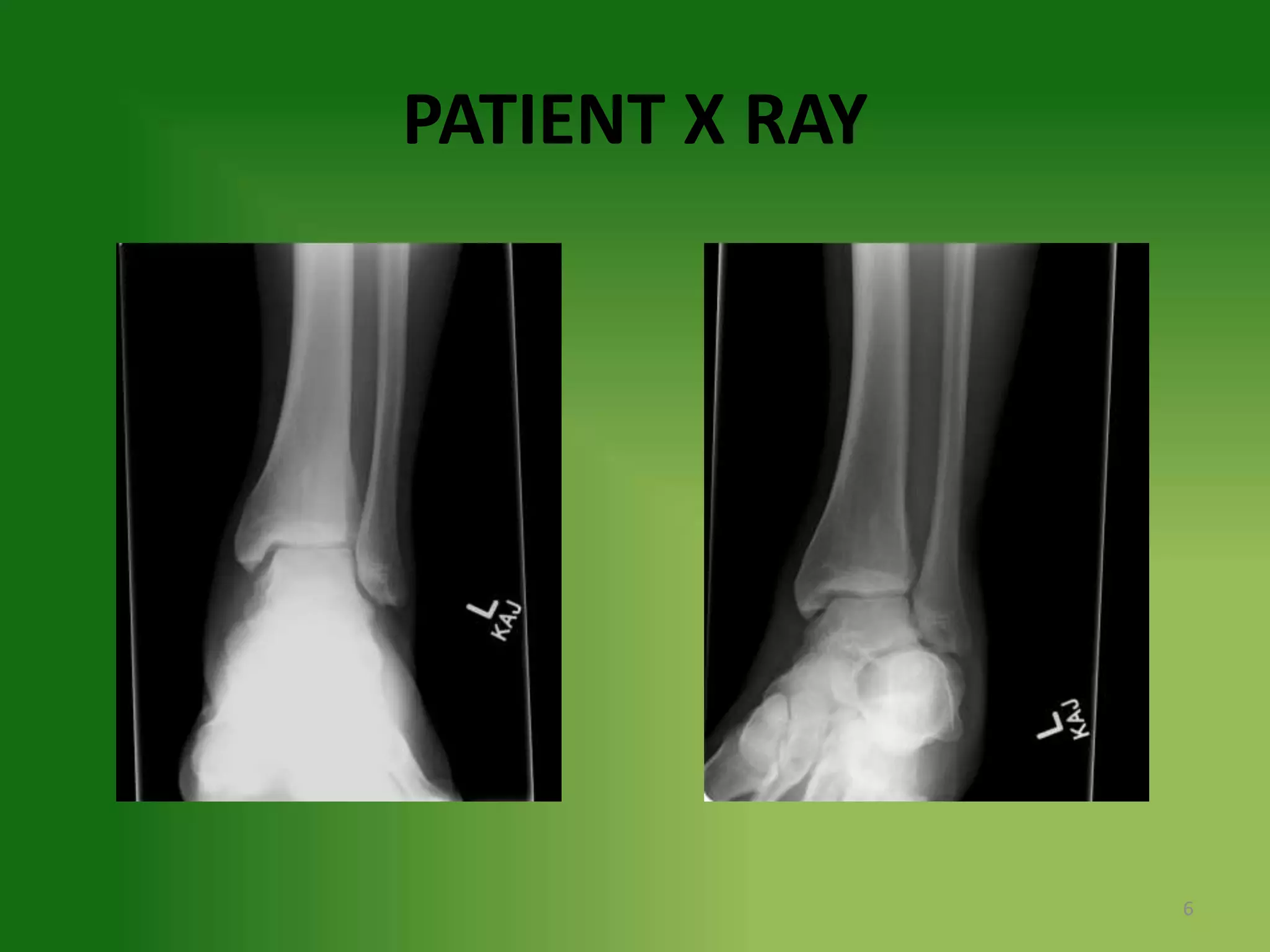 Grade 2 Ankle Sprain In A Collegiate Football Athlete PPTX Grade 2 ankle sprain in a collegiate football athlete pptx