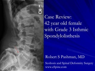 Case Review:
42 year old female
with Grade 3 Isthmic
Spondylolisthesis


Robert S Pashman, MD
Scoliosis and Spinal Deformity Surgery
www.eSpine.com
 