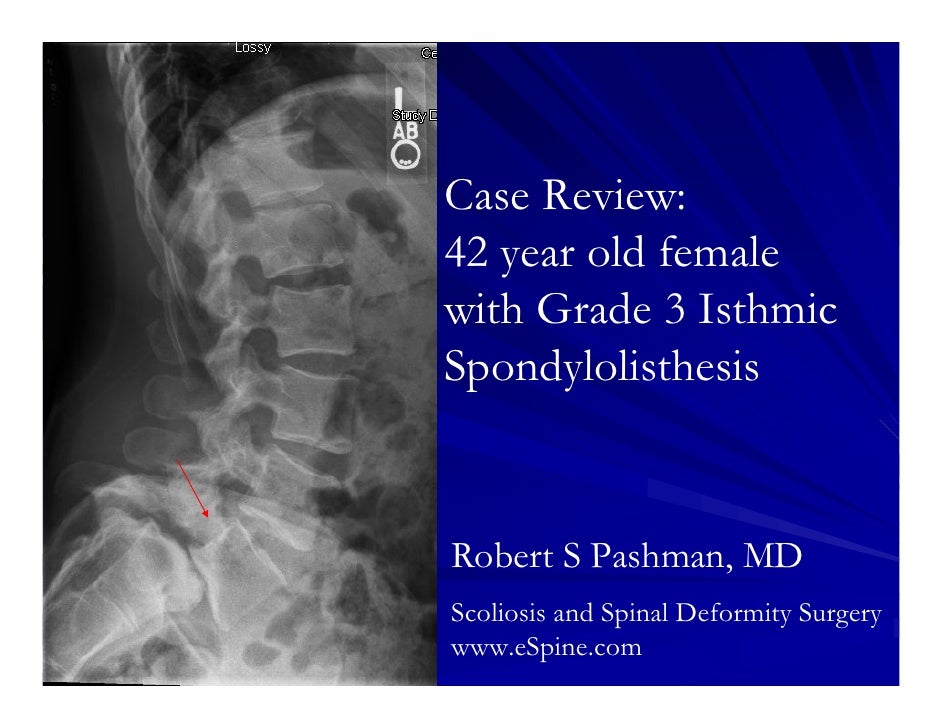 Spondylolisthesis surgery success rate image
