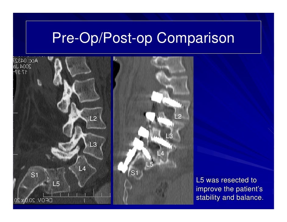 Retrolisthesis exercises pdf picture