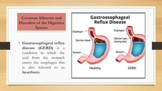 Common Ailments and
Disorders of the Digestive
System
• Gastroesophageal reflux
disease (GERD) is a
condition in which the
acid from the stomach
enters the esophagus this
is also referred to as
heartburn.
 