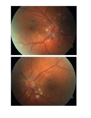 Grade four hypertensive retinopathy 2