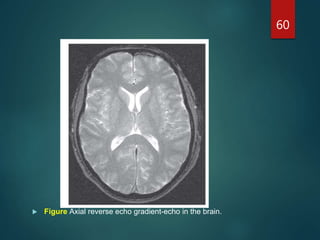 60
 Figure Axial reverse echo gradient-echo in the brain.
 