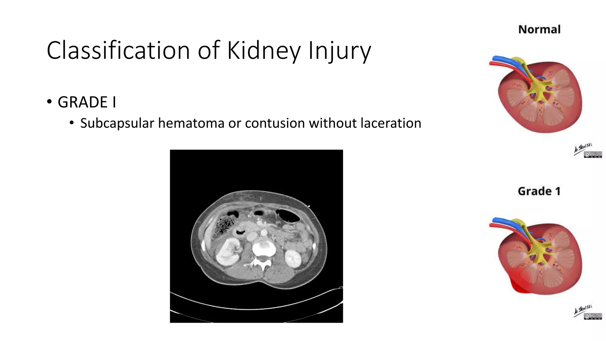 Grading Of Liver And Kidney Injuries PPTX Grading Of Liver And Kidney Injuries PPTX