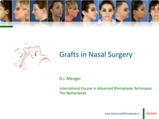 Grafts in Nasal Surgery
D.J. Menger
International Course in Advanced Rhinoplasty Techniques
The Netherlands

www.AdvancedRhinoplasty.nl

 