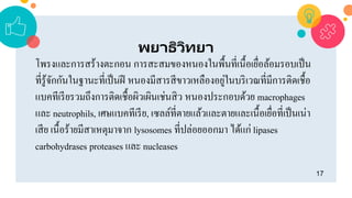 17
พยาธิวิทยา
โพรงและการสร้างตะกอน การสะสมของหนองในพื้นที่เนื้อเยื่อล้อมรอบเป็น
ที่รู้จักกันในฐานะที่เป็นฝี หนองมีสารสีขาวเหลืองอยู่ในบริเวณที่มีการติดเชื้อ
แบคทีเรียรวมถึงการติดเชื้อผิวเผินเช่นสิว หนองประกอบด้วย macrophages
และ neutrophils, เศษแบคทีเรีย, เซลล์ที่ตายแล้วและตายและเนื้อเยื่อที่เป็นเน่า
เสีย เนื้อร้ายมีสาเหตุมาจาก lysosomes ที่ปล่อยออกมา ได้แก่ lipases
carbohydrases proteases และ nucleases
 