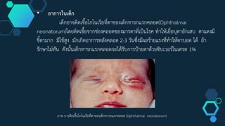 • อาการในเด็ก
เด็กอาจติดเชื้อโกโนเรียที่ตาของเด็กทารกแรกคลอด(Ophthalmai
neonatorum)โดยติดเชื้อจากช่องคลอดของมารดาที่เป็นโรค ทำให้เยื่อบุตาอักเสบ ตาแดงมี
ขี้ตามาก มีไข้สูง มักเกิดอาการหลังคลอด 2-3 วันซึ่งมีผลร้ายแรงที่ทำให้ตาบอด ได้ ถ้า
รักษาไม่ทัน ดังนั้นเด็กทารกแรกคลอดจะได้รับการป้ายตาด้วยซิบเวอร์ไนเตรต 1%
ภาพ การติดเชื้อโกโนเรียที่ตาของเด็กทารกแรกคลอด (Ophthalmai neonatorum)
 