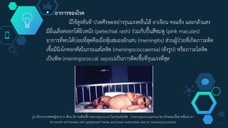 • อาการของโรค
มีไข้สูงทันที ปวดศีรษะอย่างรุนแรงคลื่นไส้ อาเจียน คอแข็ง และกลัวแสง
มีผื่นเลือดออกใต้ผิวหนัง (petechial rash) ร่วมกับปื้นสีชมพู (pink macules)
อาการที่พบได้บ่อยที่สุดคือเยื่อหุ้มสมองอักเสบ (meningitis) ส่วนผู้ป่วยที่เกิดภาวะติด
เชื้อมีนิงโกคอกคัสในกระแสโลหิต (meningococcaemia) (ดังรูป) หรือภาวะโลหิต
เป็นพิษ (meningococcal sepsis)เป็นการติดเชื้อที่รุนแรงที่สุด
รูป เด็กทารกเพศหญิงอายุ 4 เดือน มีภาวะติดเชื้อ Meningococcal ในกระแสโลหิต (meningococcaemia) พบ ลักษณะเนื้อตายที่แขน ขา
(4 month old female with gangreneof hands and lower extremities due to meningococcemia)
 