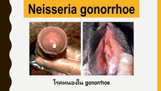 Neisseria gonorrhoe
โรคหนองใน gonorrhoe
 