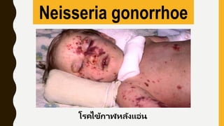 Neisseria gonorrhoe
โรคไข้กาฬหลังแอ่น
 