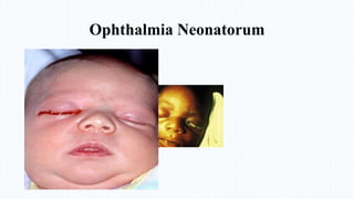 Ophthalmia Neonatorum
 